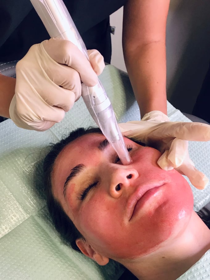 microneedling-treatment